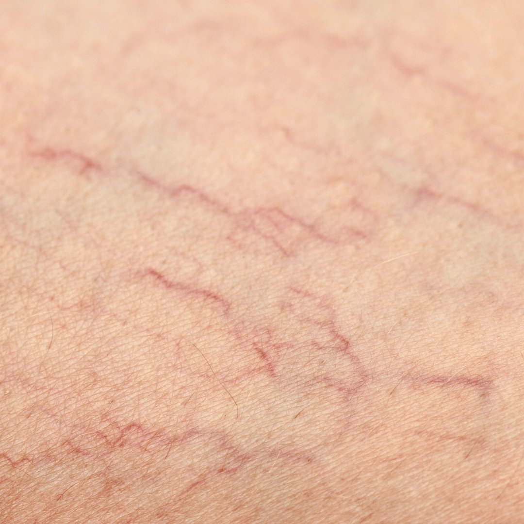 varices y arañas vasculares