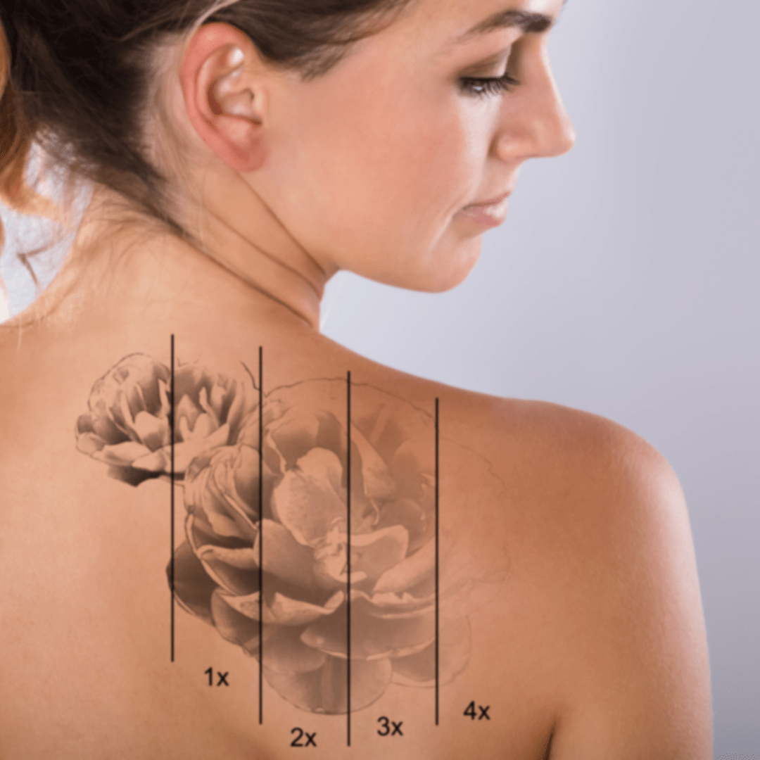 eliminación de tatuajes