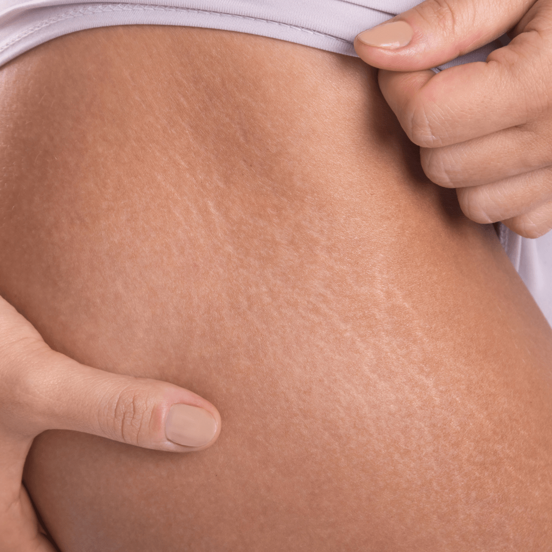 vitaminas estrías y cicatrices
